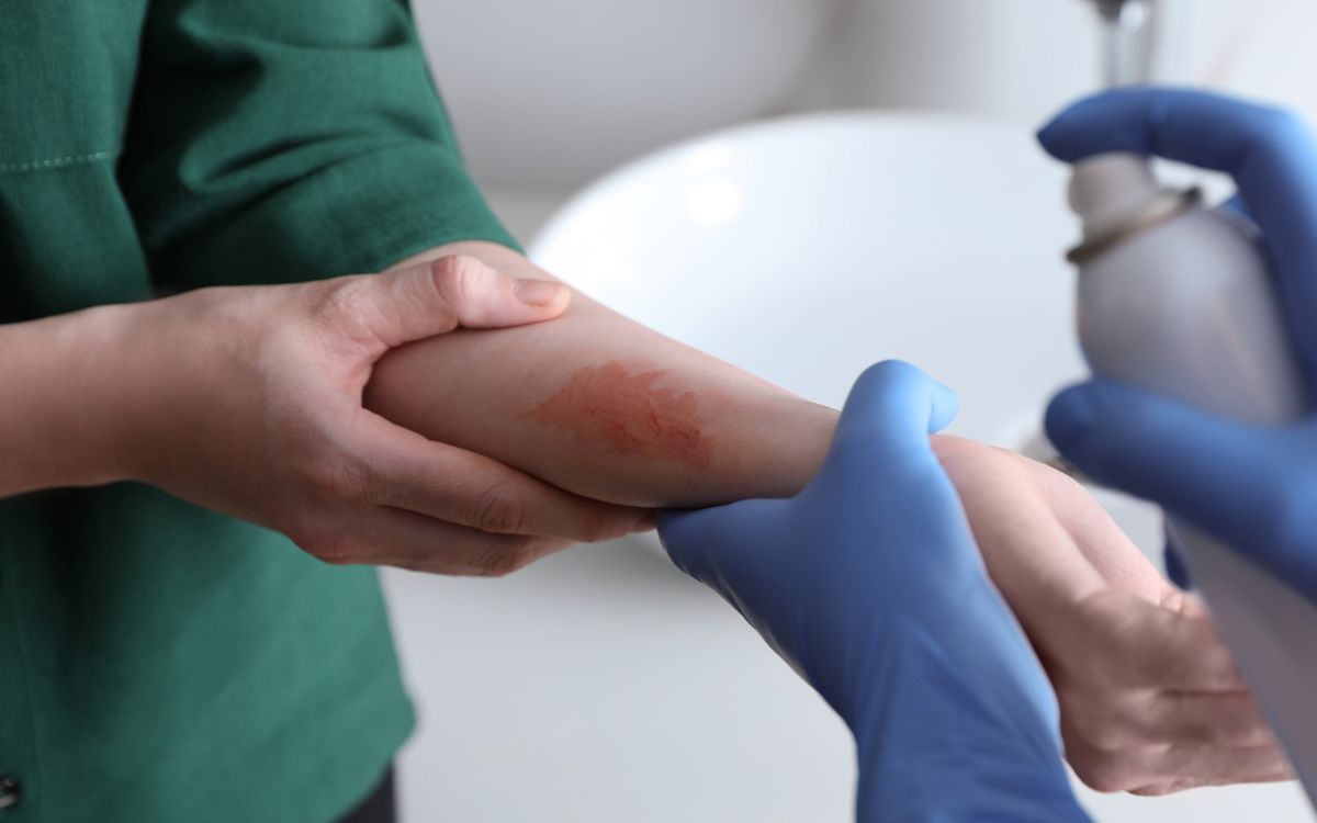 Científicos identifican mecanismo neuronal que vincula el estrés con el agravamiento del eccema